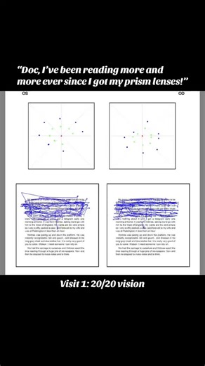 Vivid Visions Optometry, Inc on Instagram: "Look at this. This is the VR eye tracking with the prism lenses I prescribed. Over 4 visits in 7 months, you can literally see the change: • Her tracking is smoother and actually staying on the lines • The lines are more lined up and stable • She read for longer in the same amount of time And here’s the crazy part: we did zero vision therapy. On top of that, she started going to more school, got a job, and started working more. Still, her reading impro