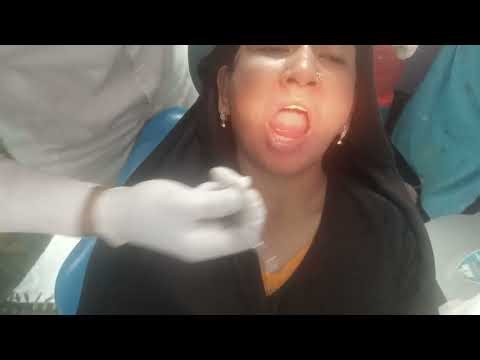 🖼️ Front Teeth Fixed! 😱RCT + Filling Done! 🦷✨ part 2 