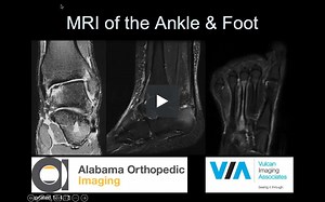 MRI of the Foot & Ankle