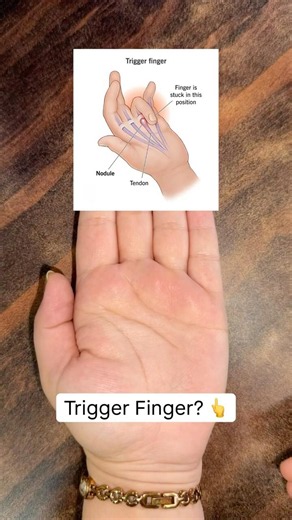 Trigger Finger Exercise | Fix Finger Locking | Transverse Friction Massage #shorts #physiotherapy