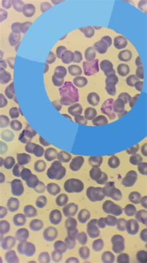 Ict Malaria vivex Positive slide
