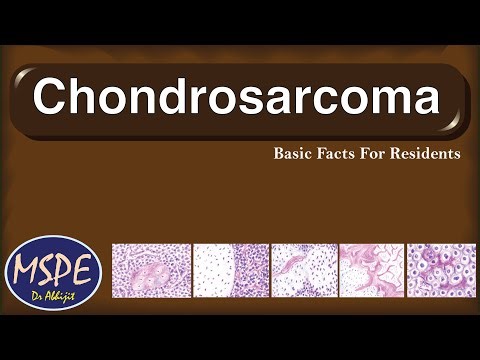 Chondrosarcoma: subtypes & salient histomorphology (basic facts for residents)