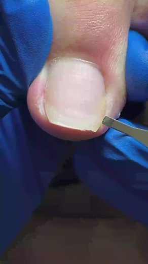 213K views · 674 reactions | #pedicure #ingrown #toenail | Ingrown Toenails | Facebook