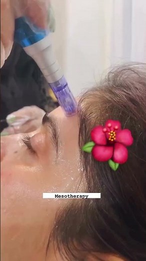 Mesotherapy 💉✨ creates tiny controlled channels in the skin, boosting collagen and improving