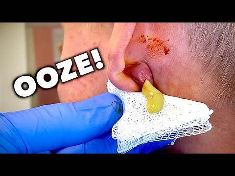 DRAINING AN EAR ABSCESS! (All the Ooze) + Slow Mo Replay | Dr. Paul