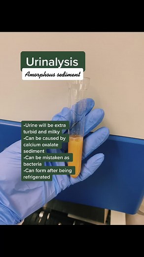 #MedicalTechnologist #lab #fyp #urinalysis 💛🧡
