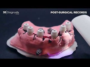 Utilizing OPTISPLINT® for All-on-X Restoration Records (GFMP – FMP) | 3DDX Digital Workflow