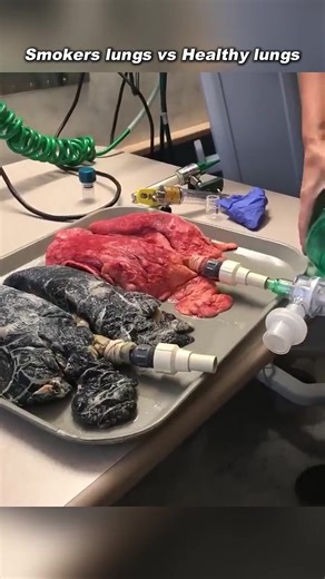 A Smoker's Lungs vs. Healthy Lungs