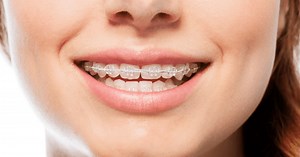 Radiance Braces: Cost, Reviews and Comparisons