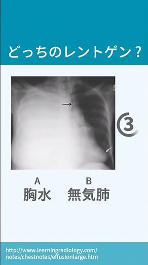 【16秒で解説】片肺が真っ白なレントゲン