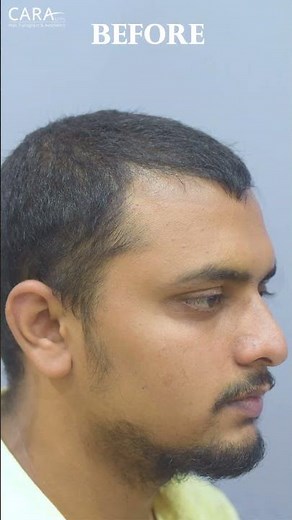 Trichometric Hair PRP at Cara Clinic - REAL Results Revealed!