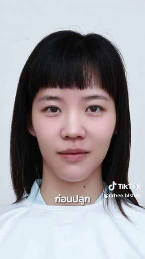เป็นอีก1เคสที่หมออยากมาแชร์คนที่มีปัญหาเหมือนในคลิปนี้นะคะ🥰 หลังปลูกผมไปหน้าเรียวสวยขึ้นเยอะ จนหมอและคนไข้ยังตกใจเลยค่ะ😂 #ปลูกผม #หมอบีปลูกผม #blshaircenter #ปลูกผมกับหมอบีbls #ปลูกผมกับหมอบี #หมอปลูกผมอเมริกันบอร์ด #ปลูกผมยาว #ปลูกผมLonghair #ปลูกผมแบบไม่ต้องโกน #ปลูกผมผู้หญิง #FUE #DHI