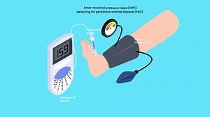 Peripheral artery disease ankle brachial index ABI test isometric 3d vector animation cartoon
