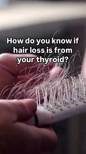 4.5K views · 50 reactions | Losing your hair can be distressing. But knowing the cause can help you learn how best to treat and manage this symptom. If a thyroid issue is behind your hair loss, there are steps you can take. If you’re noticing that you’re starting to shed more hair than usual, be sure to speak with a provider. | Cleveland Clinic | Facebook