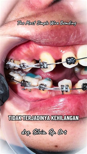 The Key to avoid Anchorage Lost Kunci untuk mencegah terjadinya kehilangan penjangkaran pada saat penarikan kaninus sebelum retraksi anterior untuk memundurkan gigi pada kasus protrusi adalah wire bending. Salam Edukasi drg. Silvia. Sp. Ort #behelgigi #behelstory #edukasi #orthodontist #fyp
