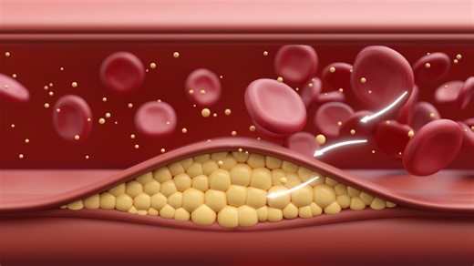 High cholesterol symptoms explained as Americans face key guideline change