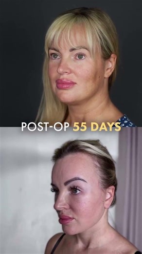 Endoscopic Forehead Lift: 55-Day Transformation (No Scalpel, No Stitches)