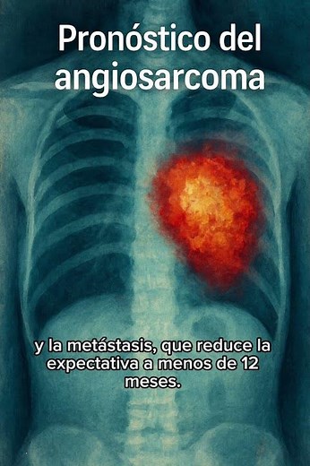 Angiosarcoma prognosis: What factors influence it? #Angiosarcoma #Prognosis #Oncology