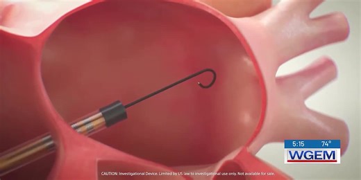 Farapulse: Smartbombs blasting AFib