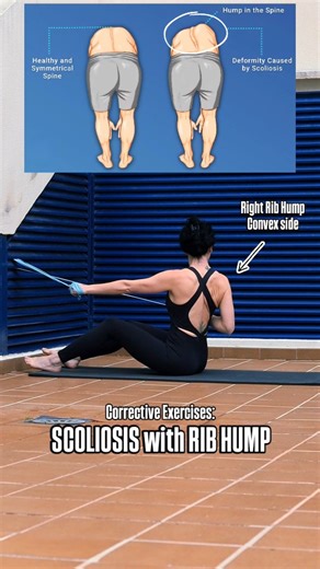 In scoliosis, the rib hump appears on the convex side of the curve due to spinal rotation and muscle imbalance. Working on the convex side with targeted strengthening and elongation helps de-rotate the spine, reduce muscle dominance, and improve rib cage alignment. This can gradually decrease the rib hump and promote a more balanced, symmetrical posture. Be Healthy!💜 - - #posture #scoliosiscorrection #ribhump #correctiveexercises #violetbalance | Violet Balance