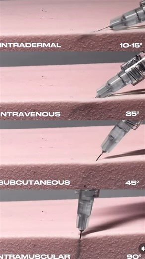 @nursepediatr on Instagram: "💉 Enjeksiyonda açı neden bu kadar önemli? Her enjeksiyon tekniğinin hedeflediği doku farklıdır. Doğru giriş açısı, ilacın doğru dokuya ulaşmasını sağlar, ağrıyı ve komplikasyon riskini azaltır. 📌 Dokuya göre iğne giriş açıları: ▫️ İntradermal (ID): 👉 5–15° İlacın dermis tabakasında kalması gerekir. Genellikle ciltte kabarcık (bleb) oluşur. ▫️ Subkutan (SC): 👉 45° (zayıf bireylerde) 👉 90° (yağ dokusu yeterliyse) İlacın yağ dokusuna verilmesi hedeflenir. ▫️ İntram