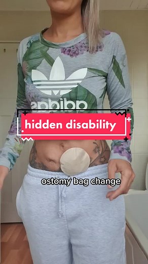 How to Change an Ostomy Bag: Step-by-Step Guide