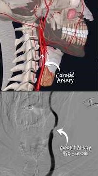 Carotid Artery Angioplasty with SpiderFX Embolic Protection Device #carotid #cardiology #cathlab