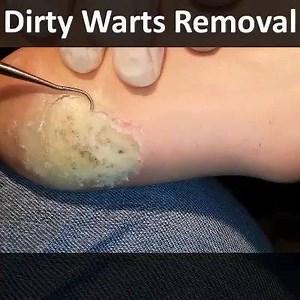 42K views · 115 reactions | Dirty Warts Removal | Pimple Popping, Cyst and Blackhead | Facebook