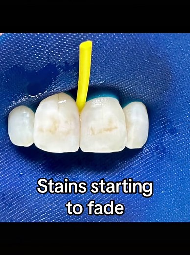 Icon Resin Infiltration Treatment for Brown and White Spots Removal
