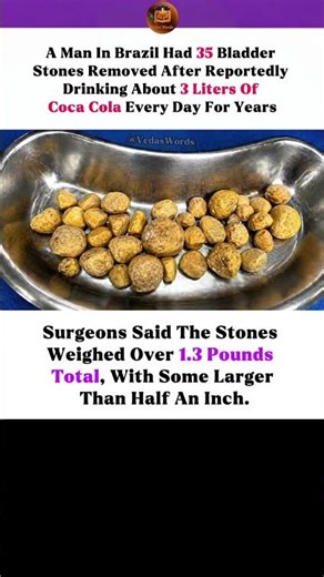​35 Bladder Stones from Drinking Too Much Soda?! 🥤🚨 #brazil #usa #cocacola #news #dangerous