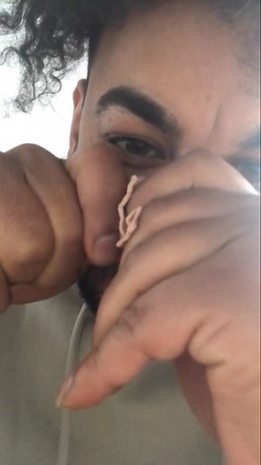 pimplepopping.tv on Instagram: "Massive ‘cheese string’ squeeze . . . 🏷: #pimple #pimplepopping #pores #pimplepop #pimples #acne #blackheads #whiteheads #blackheads #blackheadremover #blackhead"