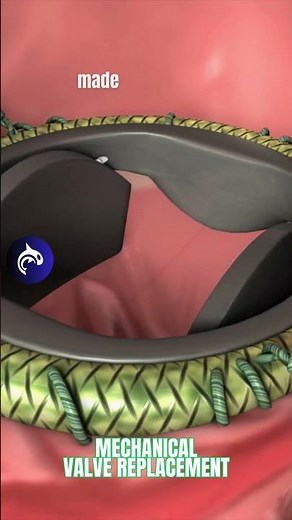 What happens when you need a new Heart Valve? #valvereplacement