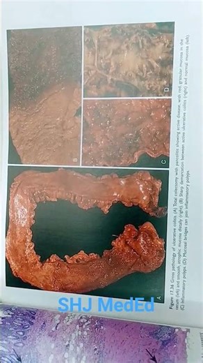 inflammatory bowel disease, Crohn disease,Ulcerative colitis,Crypt abscess, Hyperplastic polyp.,etc