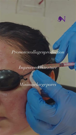 Microneedling with PRP (Vampire Facial)