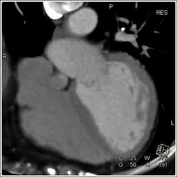 Cardiac: left main coronary artery and bifurcation of LAD and circumflex (1 of 2)