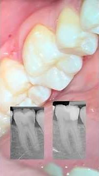 Vital Pulp Therapy With Biodentine | Deep Caries Management