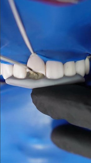 Class IV Composite Restoration – Step by Step