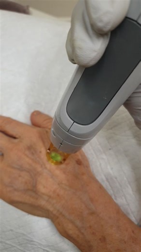 Laser Pigmentation Removal Laser pigmentation removal targets unwanted dark spots—such as sunspots, freckles, and age spots—by using precise light energy to break down excess melanin (pigment). Once shattered, the pigment gradually rises to the skin’s surface and flakes away, revealing clearer, brighter, and more even-toned skin. Most people require multiple sessions, and although downtime is minimal, consistent sun protection is essential for best results. This treatment is most suitable for li