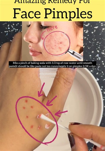 Effective Remedy for Face Pimples Using Baking Soda
