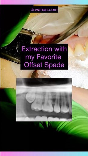 Discover How to Safely Extract Your Upper Wisdom Tooth! #shorts