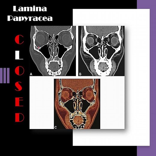 Nose radiology series (5): The lamina papyracea (1) #shorts