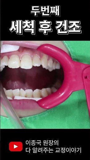 Orthodontic treatment begins! Bracket attachment process #Orthodontics #Braces #Braces