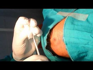 Sebaceous (Epidermoid ) cyst forehead: No scar..