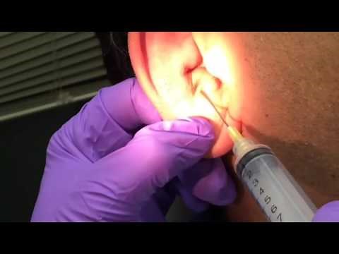Aspiration of Auricular Hematoma (cauliflower ear)