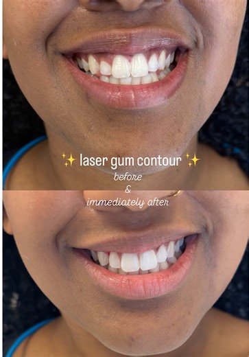 Laser Gum Contouring: Transform Your Smile Pain-Free