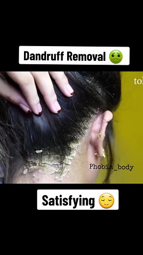 Satisfying Dandruff Removal Techniques