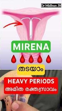 Mirena : മരുന്നോ സർജറിയോ ഇല്ലാതെ bleeding നിർത്താം.