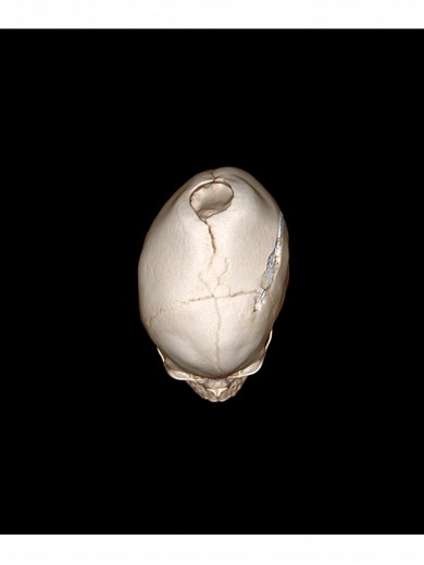 Navigating Craniotomy Surgery: A Supportive Journey