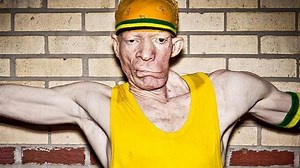 Yellowman Maladie