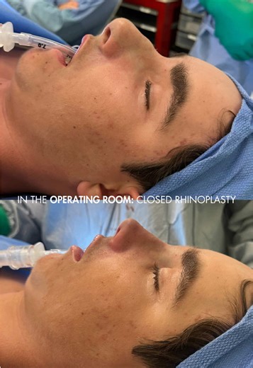 Come into the operating room with me as I perform a scarless (closed) rhinoplasty on a young male patient. This advanced technique allows for precise nasal reshaping without external scars and with a focus on balanced, natural results. All procedures have risks, please consult your doctor for medical advice. #Rhinoplasty #ClosedRhinoplasty #NoseJob #ScarlessRhinoplasty #RhinoplastyBeforeAfter